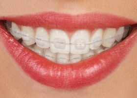 ceramic braces
