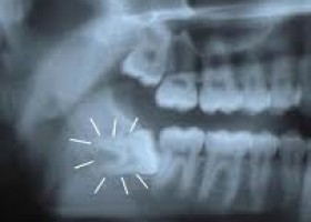 impacted teeth