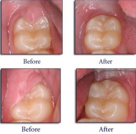 impacted teeth
